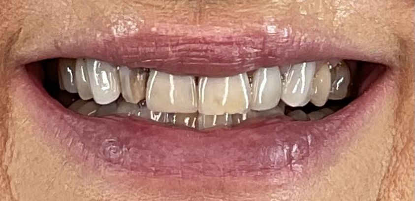 Smile Gallery Before