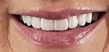 Smile Gallery After